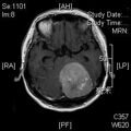 MRI дооперационный (26)