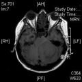 MRI дооперационный (20)