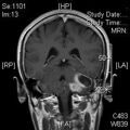 MRI дооперационный (20)