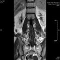 MRI дооперационный (24)
