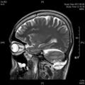 MRI послеоперационный (8)