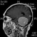 MRI дооперационный (30)