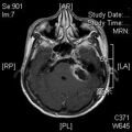 MRI дооперационный (13)