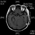 MRI дооперационный (22)