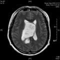 MRI дооперационный (2)