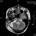 MRI послеоперационный (7)