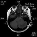 MRI дооперационный (19)