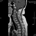 MRI дооперационный (13)
