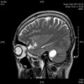 MRI дооперационный (5)