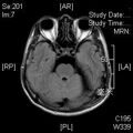 MRI послеоперационный (3)