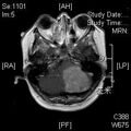 MRI дооперационный (23)