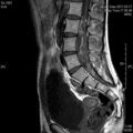 MRI дооперационный (2)