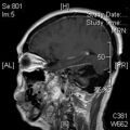 MRI послеоперационный (19)