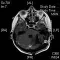 MRI послеоперационный (16)