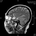 MRI дооперационный (6)